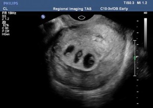 ultrazvuk-majka-pozeljela-djevojcicu