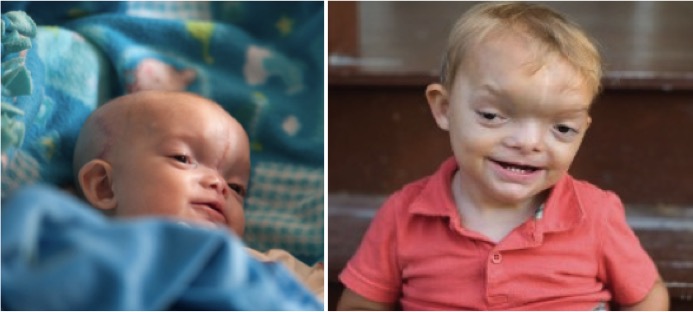 Dominic nakon operacije (lijevo), Dominic nakon dvije godine (desno); Foto: Boston Children's Hospital Blog