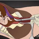 kako izgleda abortus
