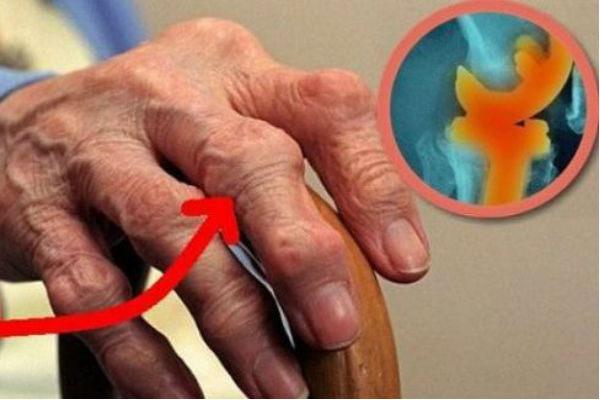 lijekovi protiv bolova u zglobovima kod starijih osoba bol u zglobovima ruku u jutarnjim satima