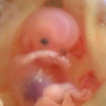 abortirani fetusi