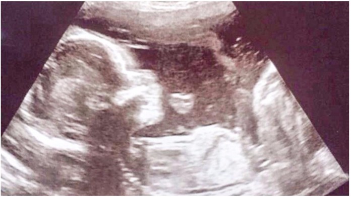 Majka i ginekolog se iznenadili kada su vidjeli ovaj prizor na ultrazvuku