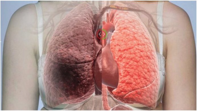 Što uzrokuje rak pluća