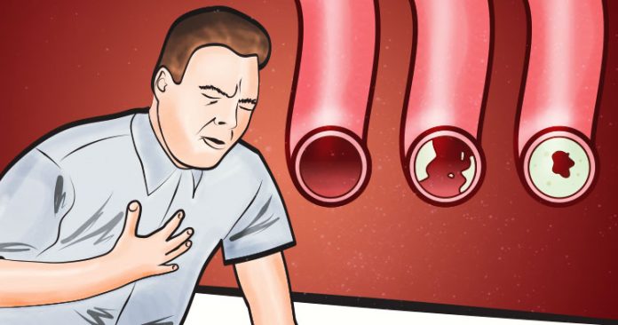 namirnice čišćenje arterija