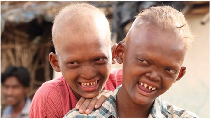 Dva brata imaju rijetku bolest zbog koje ostaju bez dijelova lica