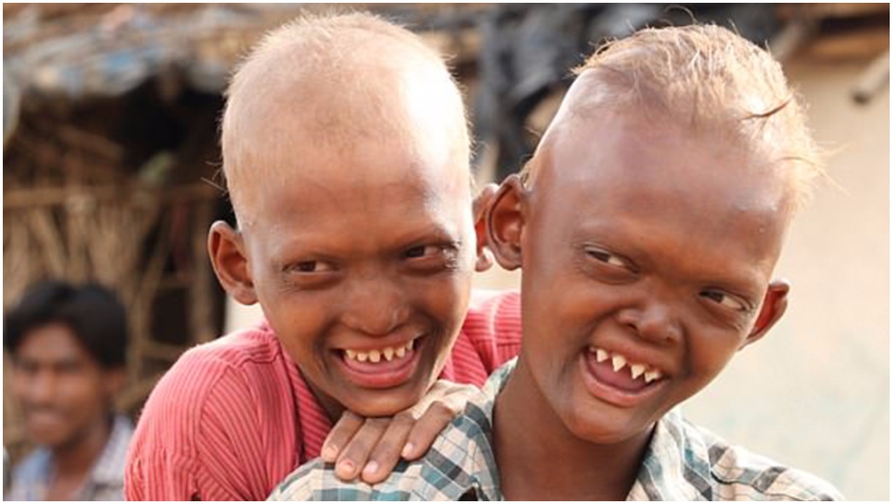 Dva brata imaju rijetku bolest zbog koje ostaju bez dijelova lica