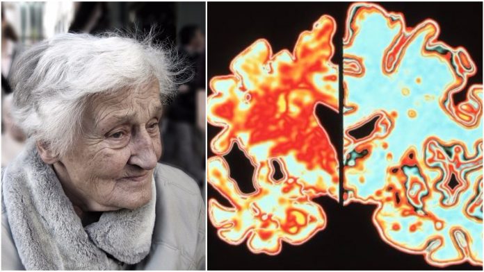 prepoznati simptome alzheimera