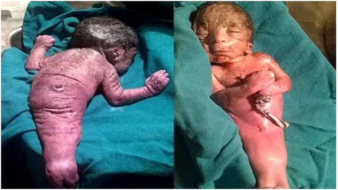 Djevojčici rođenoj sa spojenim nogama su davali samo 72 sata života