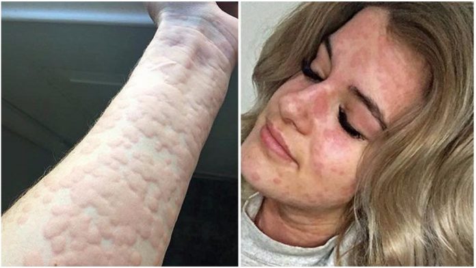 Žena alergična na zimu može umrijeti ako se dobro ne obuče Žena alergična na zimu može umrijeti ako se dobro ne obuče