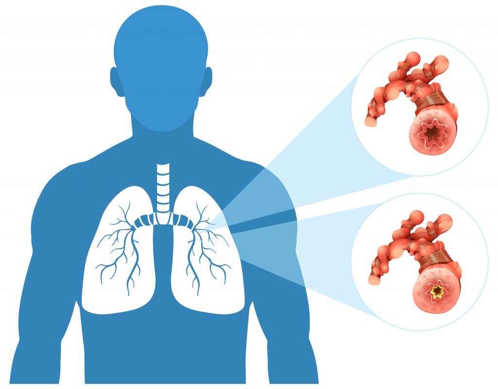 Znakovi koji upućuju na rak u plućima čak i ako nismo pušači