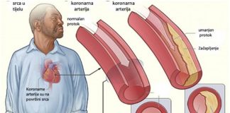 Ljekoviti napitak od češnjaka i limuna za čišćenje arterija