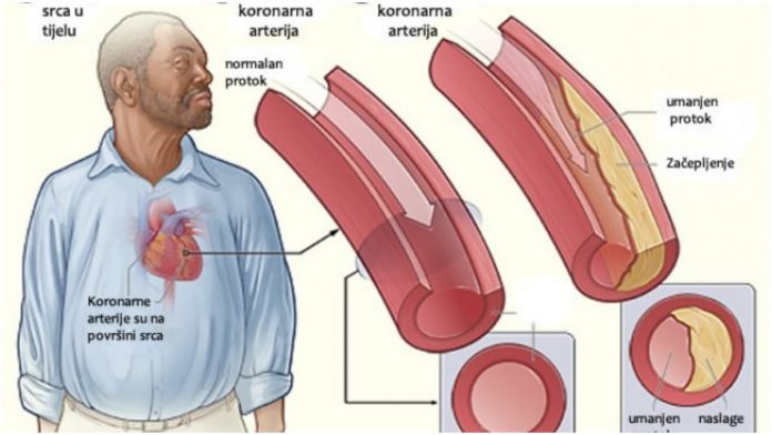 Ljekoviti napitak od češnjaka i limuna za čišćenje arterija