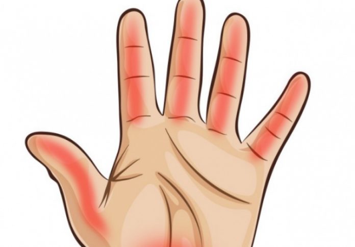 dlanovi ruke otkrivaju bolesti