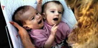 Doktori su razdvojili sijamske blizanke kada su imale 6 mjeseci