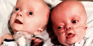 deformirani blizanci