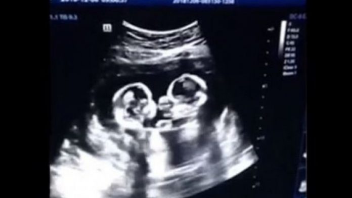 Roditelji su se iznenadili kada su na ultrazvuku vidjeli što blizanke rade Roditelji su se iznenadili kada su na ultrazvuku vidjeli što blizanke rade