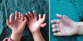 Djevojčica rođena s 14 prstiju