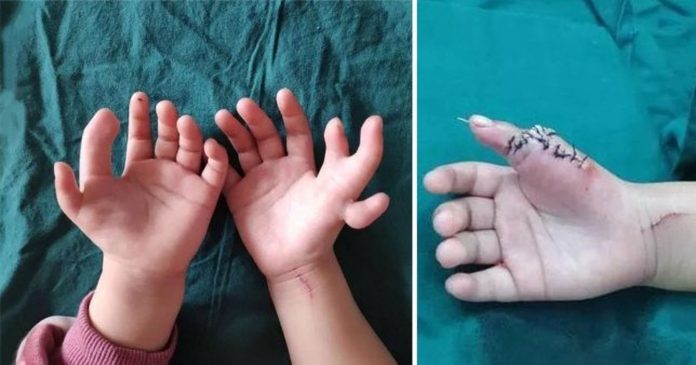 Djevojčica rođena s 14 prstiju