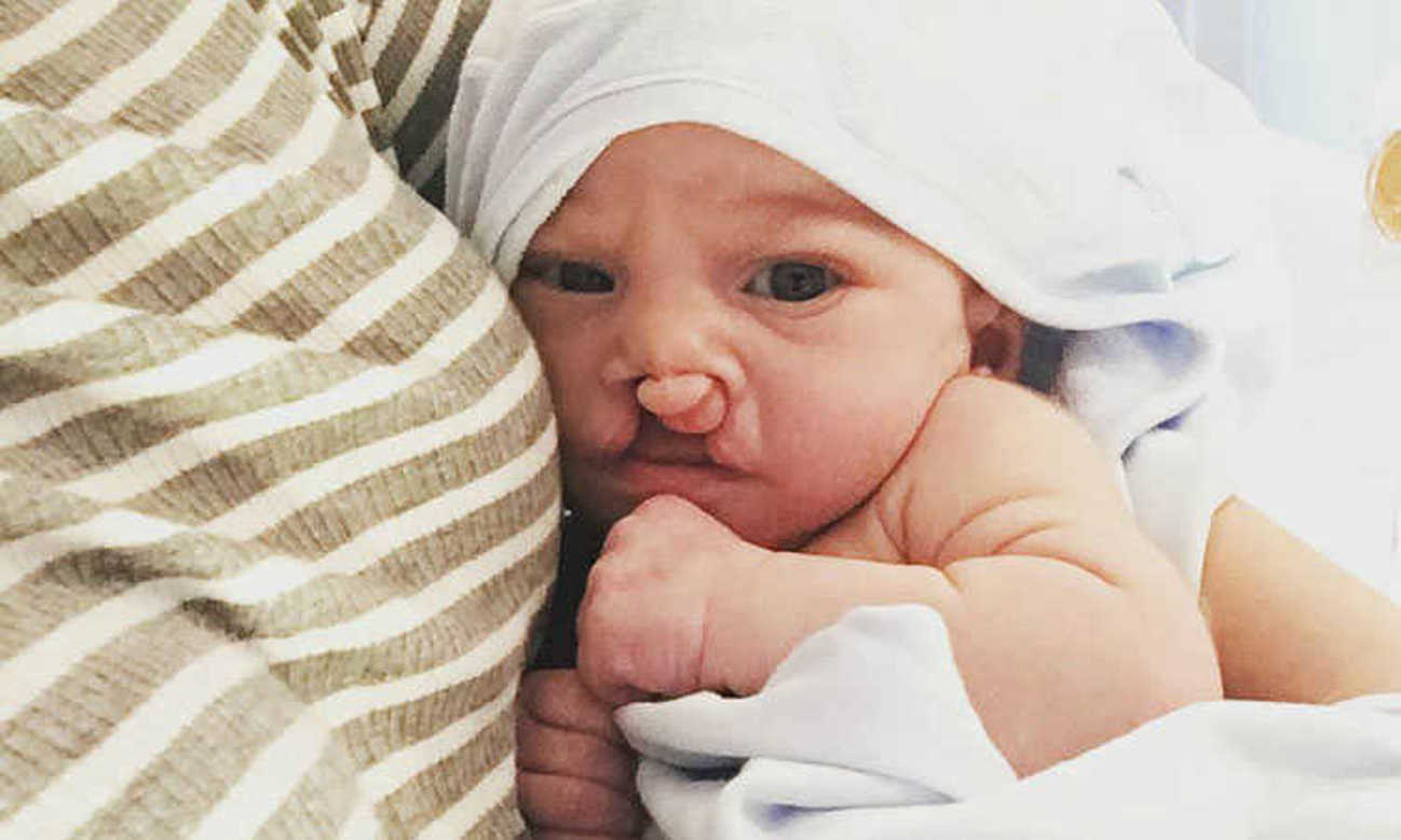 Mama objavila fotografije sina rođenog s deformiranom usnom i nepcem