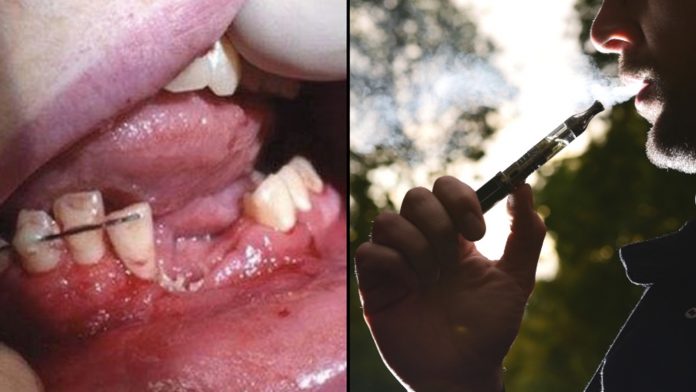 električna cigareta eksplodirala Električna cigareta mu uništila lice nakon što mu je eksplodirala u ustima
