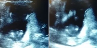 Roditelji na ultrazvuku primijetili nešto što nisu očekivali