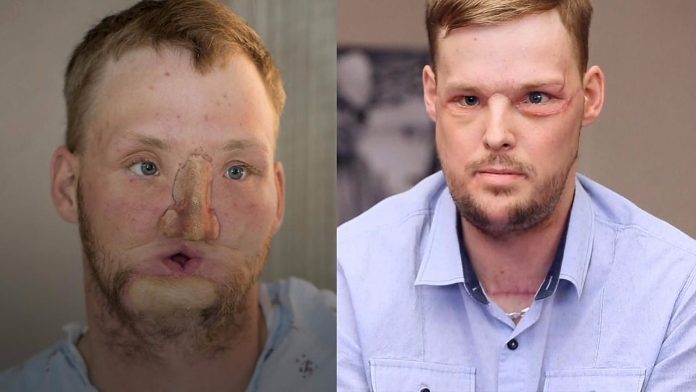 Mladić (21) prošao kroz nevjerojatnu operaciju transplantacije lica