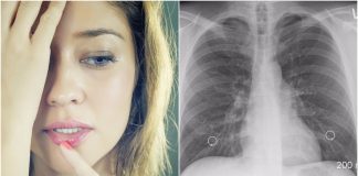 Jedna pojava na licu može biti simptom rak pluća