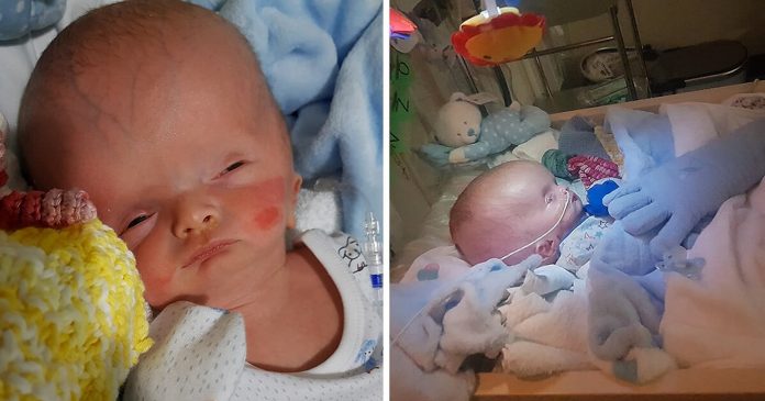 Beba rođena s natečenom glavom zadivljuje liječnike i roditelje