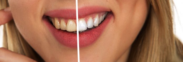 Prirodne metode za izbjeljivanje zubi