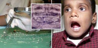 Dječaku izvadili 526 zuba, nije bio svjestan što mu je u ustima