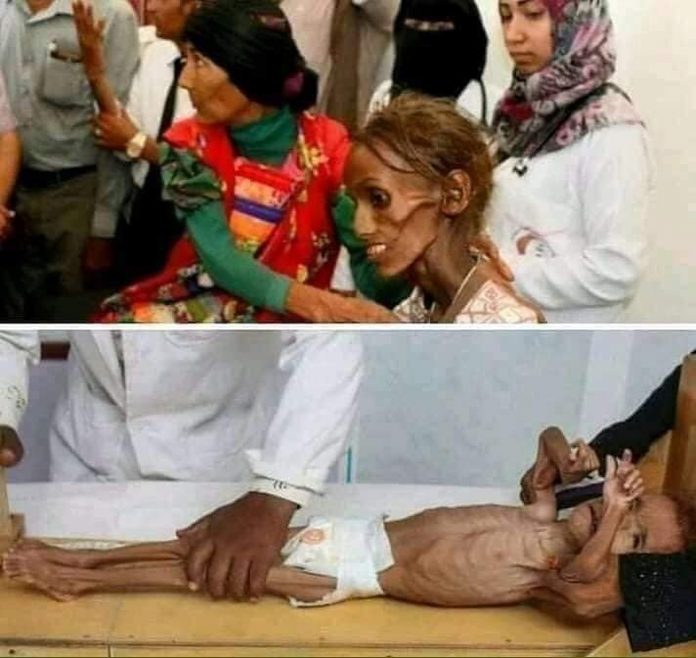 U Jemenu ljudi umiru od gladi, a nitko o tome ne piše