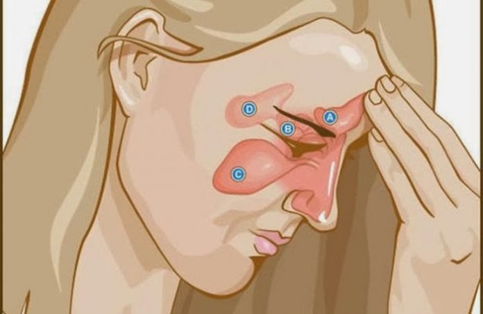 Bol u sinusima: Prirodni lijekovi