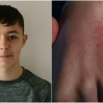 Dječak (13) se bori za život: Počelo je osipom i crvenim očima