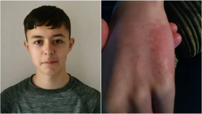 Dječak (13) se bori za život: Počelo je osipom i crvenim očima