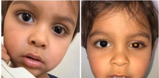 Mrlja u dječakovom oku je otkrila šokantnu dijagnozu