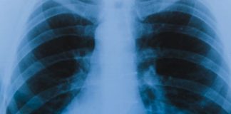 Je li rak pluća izlječiv