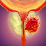 Prevencija raka prostate