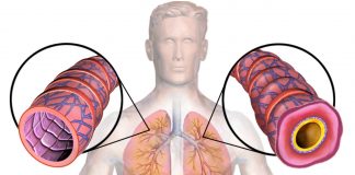 Astma je bolest koja nema lijeka: Kako je prepoznati i spriječiti?