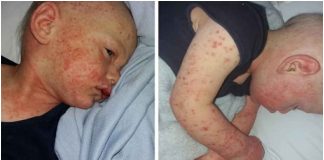 Osip opasan po život dječak završio u bolnici zbog poljupca