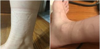 Tragovi od čarapa: Što otkrivaju o vašem zdravlju?