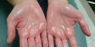 Znojni dlanovi