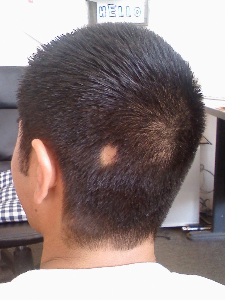 Alopecia areata