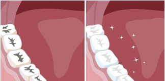 Karijes: Prirodni načini koji će zaštititi vaše zube