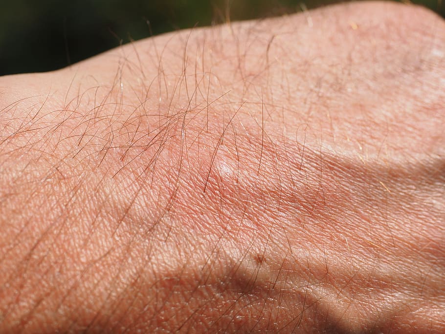 Svrbež kože mogu uzrokovati ugrizi kukaca i buba 