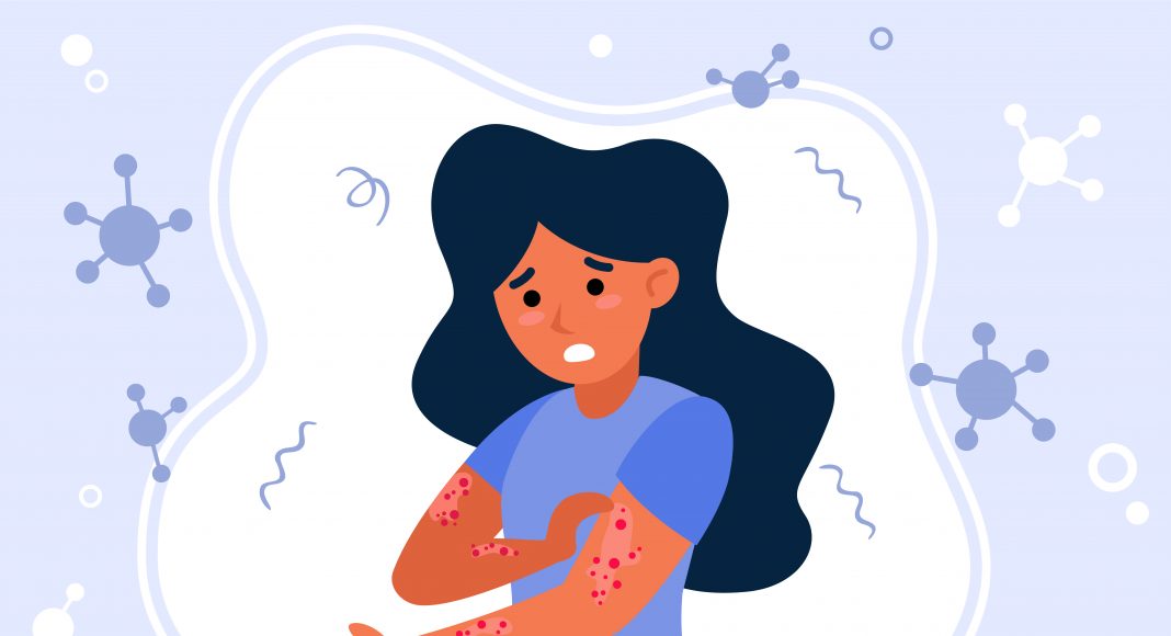 Psorijaza