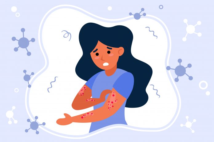 Psorijaza
