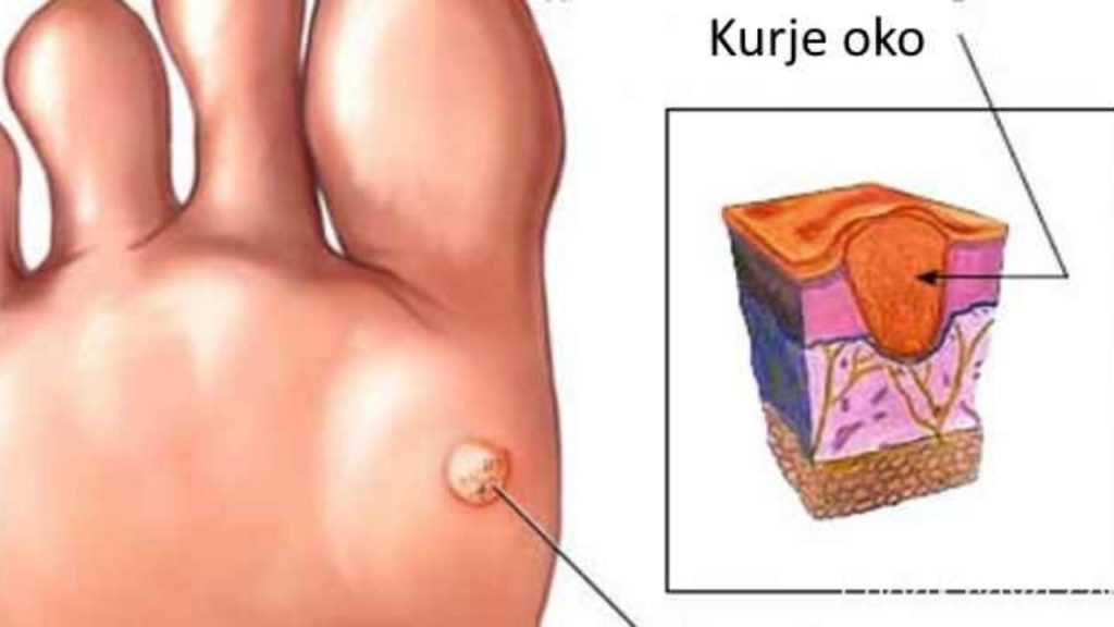 Kako liječiti kurje oko