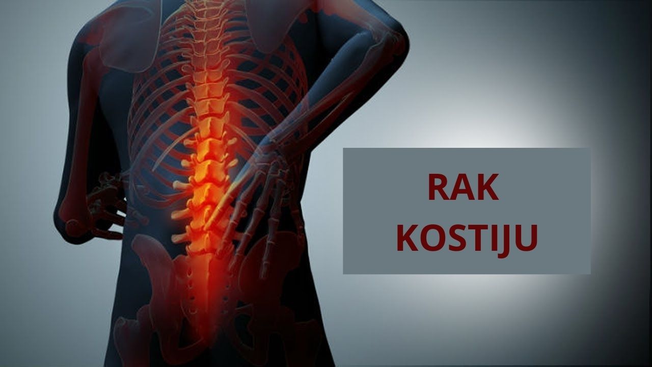 Rak kostiju