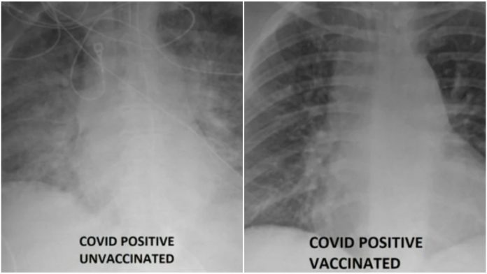 Kako izgledaju pluća cijepljenih i necijepljenih zaraženih pacijenata