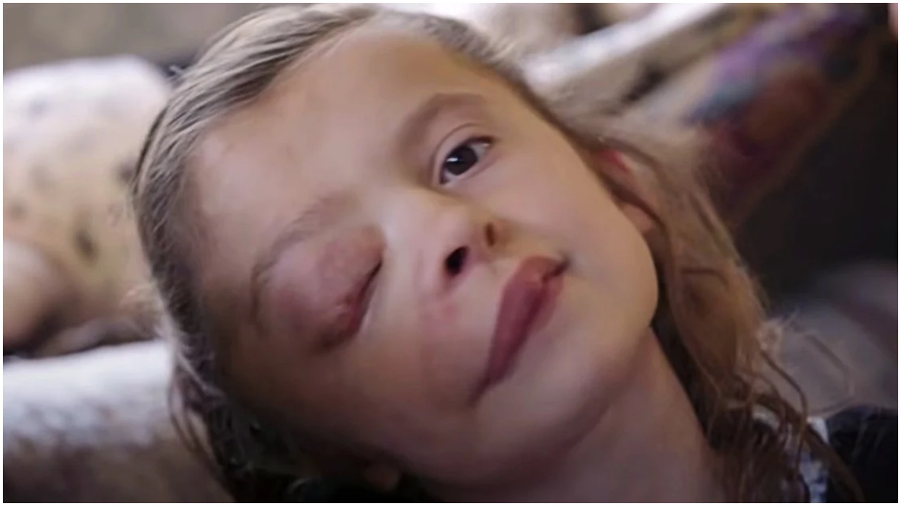 Djevojčica s tumorom na licu